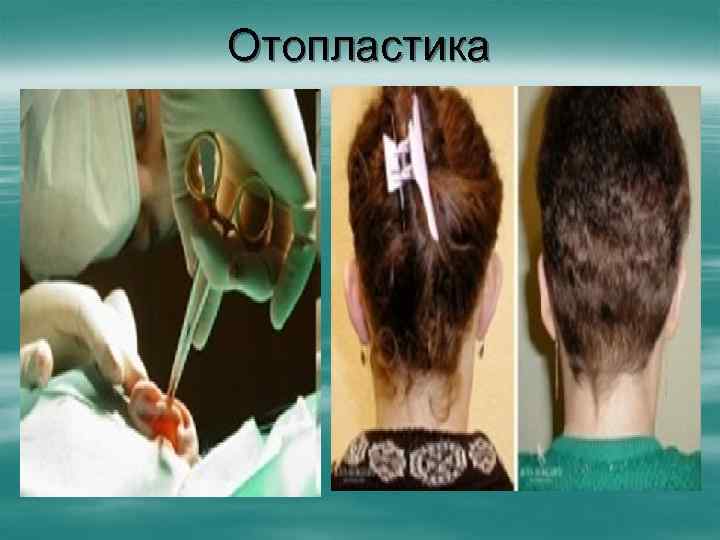 Отопластика 