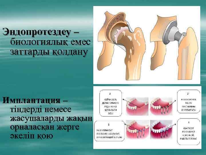 Эндопротездеу – биологиялық емес заттарды қолдану Имплантация – тіндерді немесе жасушаларды жақын орналасқан жерге