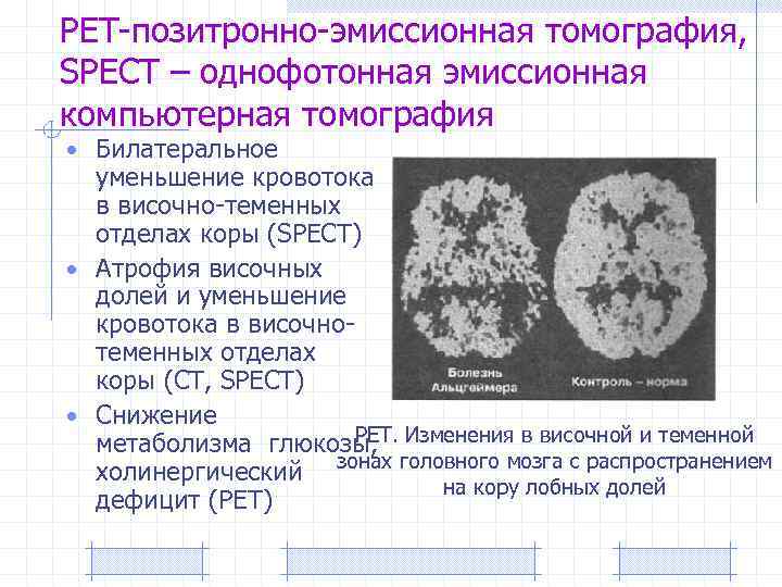 РЕТ-позитронно-эмиссионная томография, SPECT – однофотонная эмиссионная компьютерная томография • Билатеральное уменьшение кровотока в височно-теменных