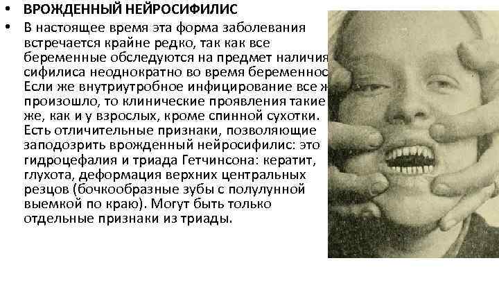  • ВРОЖДЕННЫЙ НЕЙРОСИФИЛИС • В настоящее время эта форма заболевания встречается крайне редко,
