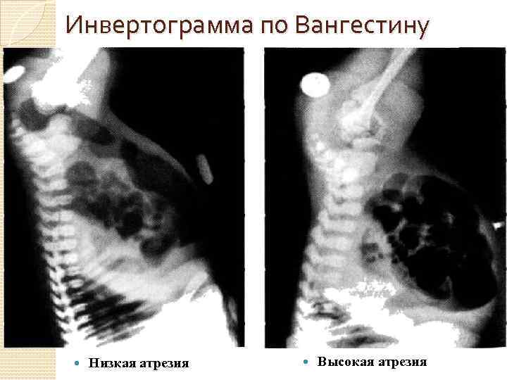 Инвертограмма по Вангестину Низкая атрезия Высокая атрезия 