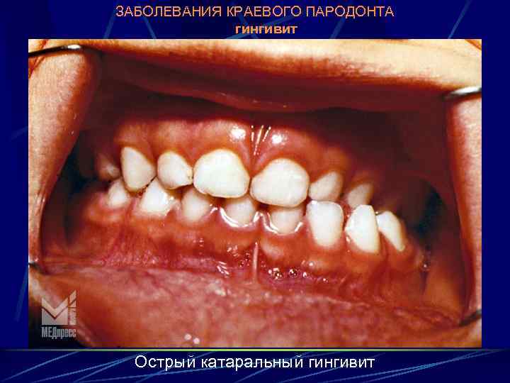 ЗАБОЛЕВАНИЯ КРАЕВОГО ПАРОДОНТА гингивит Острый катаральный гингивит 
