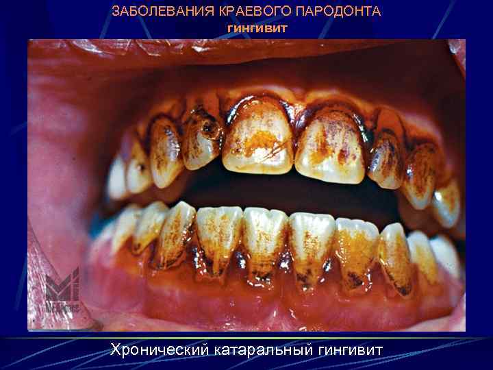 ЗАБОЛЕВАНИЯ КРАЕВОГО ПАРОДОНТА гингивит Хронический катаральный гингивит 
