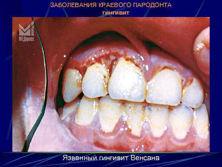 ЗАБОЛЕВАНИЯ КРАЕВОГО ПАРОДОНТА гингивит Язвенный гингивит Венсана 