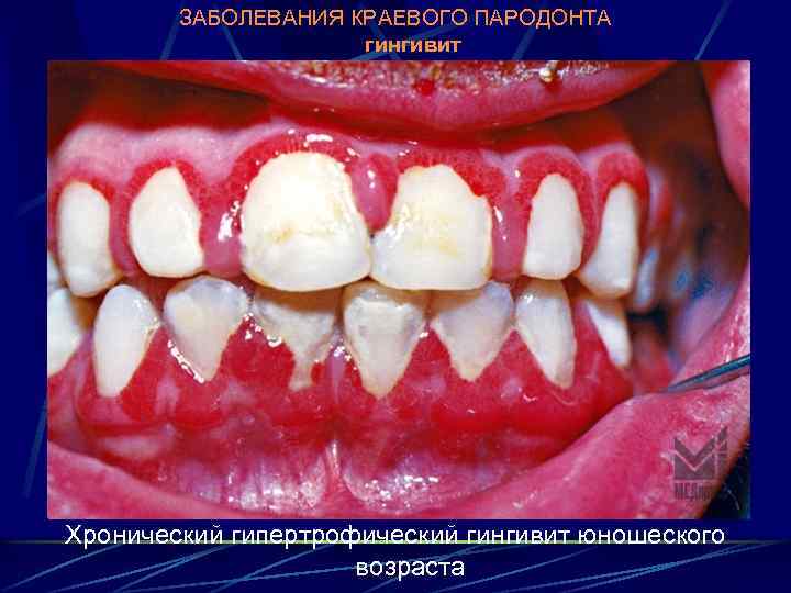 ЗАБОЛЕВАНИЯ КРАЕВОГО ПАРОДОНТА гингивит Хронический гипертрофический гингивит юношеского возраста 