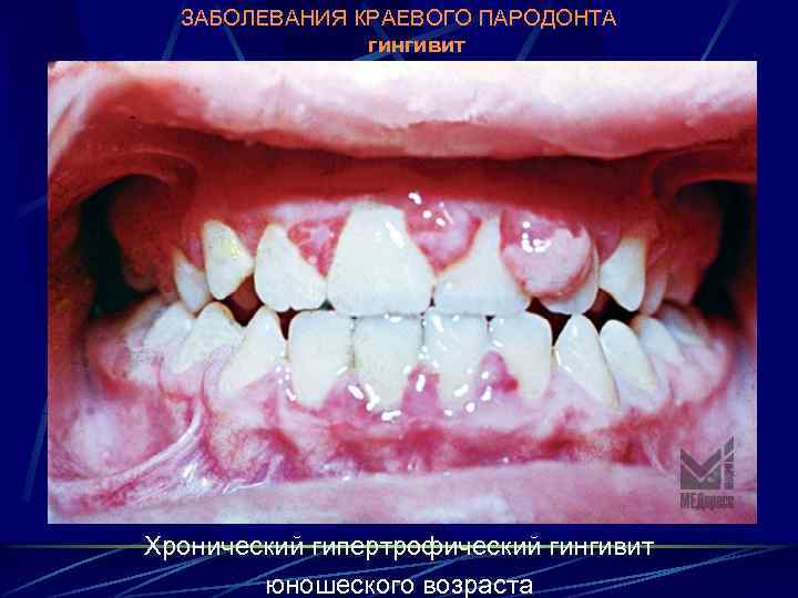 ЗАБОЛЕВАНИЯ КРАЕВОГО ПАРОДОНТА гингивит Хронический гипертрофический гингивит юношеского возраста 