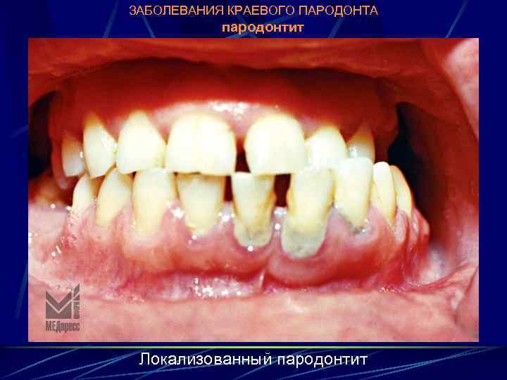 ЗАБОЛЕВАНИЯ КРАЕВОГО ПАРОДОНТА пародонтит Локализованный пародонтит 