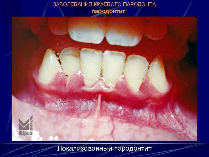 ЗАБОЛЕВАНИЯ КРАЕВОГО ПАРОДОНТА пародонтит Локализованный пародонтит 