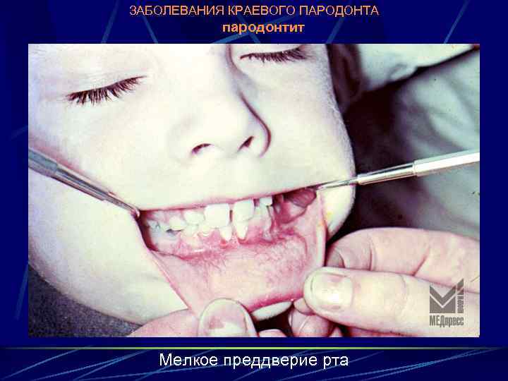 ЗАБОЛЕВАНИЯ КРАЕВОГО ПАРОДОНТА пародонтит Мелкое преддверие рта 