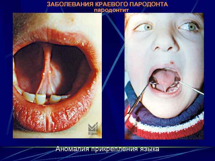 ЗАБОЛЕВАНИЯ КРАЕВОГО ПАРОДОНТА пародонтит Аномалия прикрепления языка 