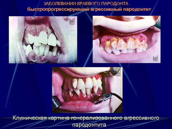 ЗАБОЛЕВАНИЯ КРАЕВОГО ПАРОДОНТА быстропрогрессирующий агрессивный пародонтит Клиническая картина генерализованного агрессивного пародонтита 