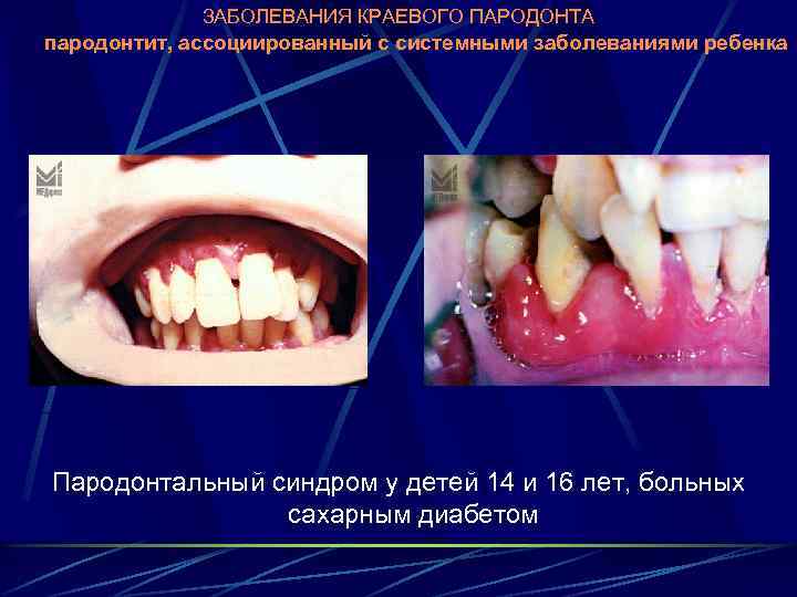 ЗАБОЛЕВАНИЯ КРАЕВОГО ПАРОДОНТА пародонтит, ассоциированный с системными заболеваниями ребенка Пародонтальный синдром у детей 14