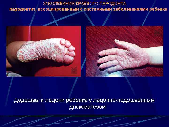 ЗАБОЛЕВАНИЯ КРАЕВОГО ПАРОДОНТА пародонтит, ассоциированный с системными заболеваниями ребенка Додошвы и ладони ребенка с
