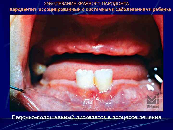 ЗАБОЛЕВАНИЯ КРАЕВОГО ПАРОДОНТА пародонтит, ассоциированный с системными заболеваниями ребенка Ладонно-подошвенный дискератоз в процессе лечения