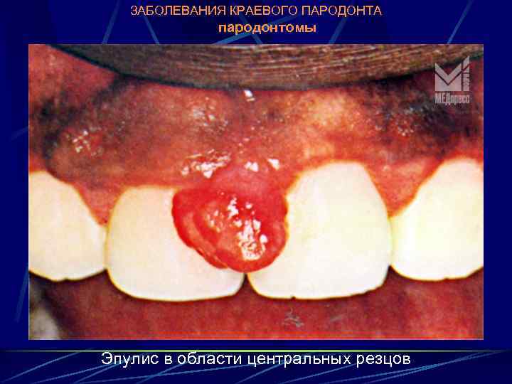 ЗАБОЛЕВАНИЯ КРАЕВОГО ПАРОДОНТА пародонтомы Эпулис в области центральных резцов 