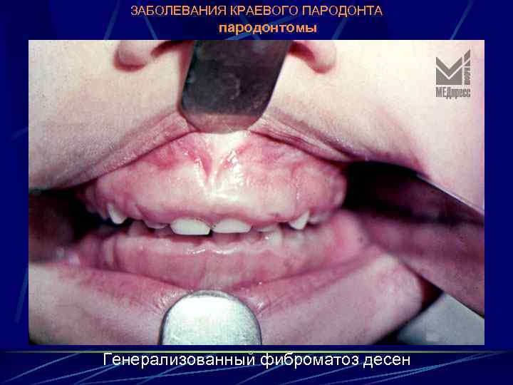 ЗАБОЛЕВАНИЯ КРАЕВОГО ПАРОДОНТА пародонтомы Генерализованный фиброматоз десен 