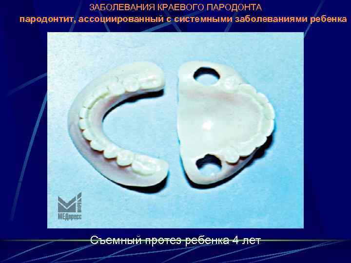 ЗАБОЛЕВАНИЯ КРАЕВОГО ПАРОДОНТА пародонтит, ассоциированный с системными заболеваниями ребенка Съемный протез ребенка 4 лет