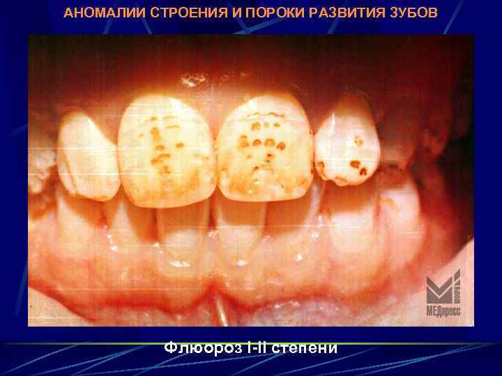 АНОМАЛИИ СТРОЕНИЯ И ПОРОКИ РАЗВИТИЯ ЗУБОВ Флюороз I-II степени 