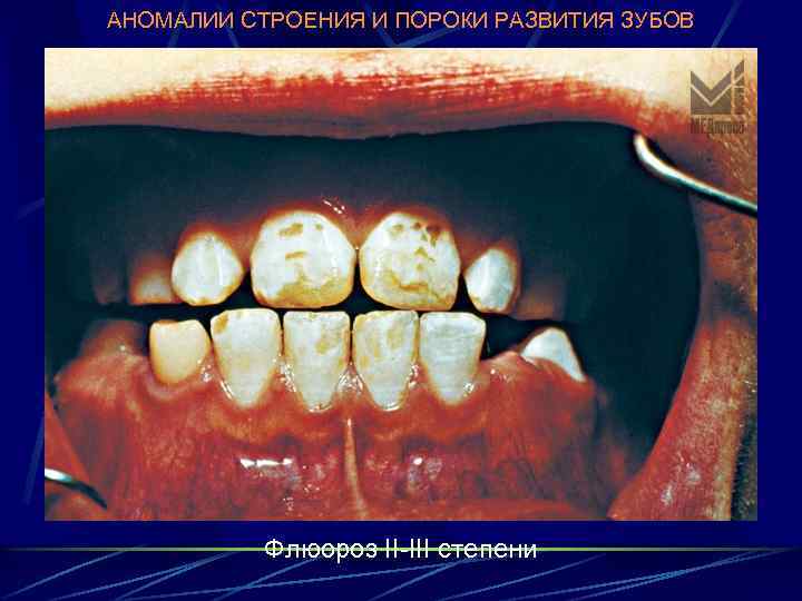 АНОМАЛИИ СТРОЕНИЯ И ПОРОКИ РАЗВИТИЯ ЗУБОВ Флюороз II-III степени 