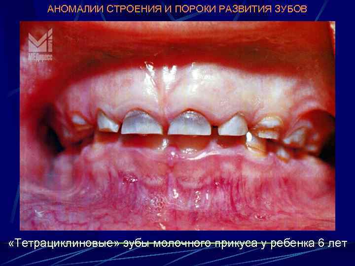 АНОМАЛИИ СТРОЕНИЯ И ПОРОКИ РАЗВИТИЯ ЗУБОВ «Тетрациклиновые» зубы молочного прикуса у ребенка 6 лет