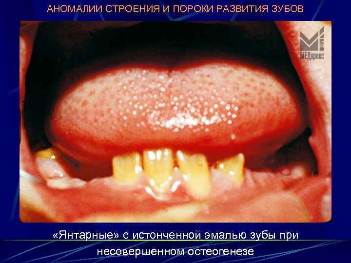 АНОМАЛИИ СТРОЕНИЯ И ПОРОКИ РАЗВИТИЯ ЗУБОВ «Янтарные» с истонченной эмалью зубы при несовершенном остеогенезе