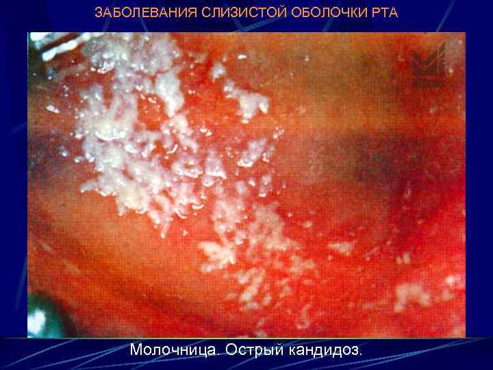 ЗАБОЛЕВАНИЯ СЛИЗИСТОЙ ОБОЛОЧКИ РТА Молочница. Острый кандидоз. 