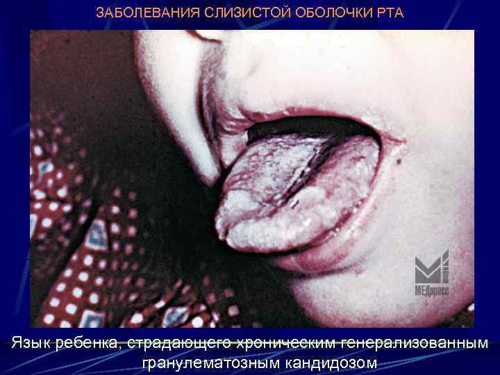 ЗАБОЛЕВАНИЯ СЛИЗИСТОЙ ОБОЛОЧКИ РТА Язык ребенка, страдающего хроническим генерализованным гранулематозным кандидозом 