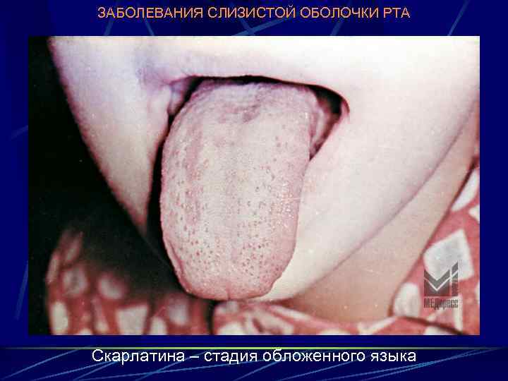 ЗАБОЛЕВАНИЯ СЛИЗИСТОЙ ОБОЛОЧКИ РТА Скарлатина – стадия обложенного языка 
