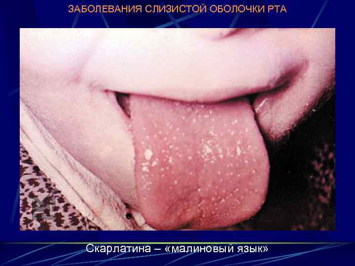 ЗАБОЛЕВАНИЯ СЛИЗИСТОЙ ОБОЛОЧКИ РТА Скарлатина – «малиновый язык» 