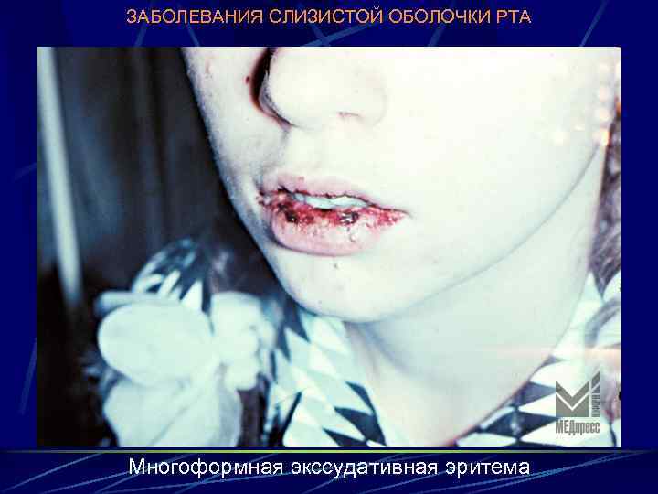 ЗАБОЛЕВАНИЯ СЛИЗИСТОЙ ОБОЛОЧКИ РТА Многоформная экссудативная эритема 
