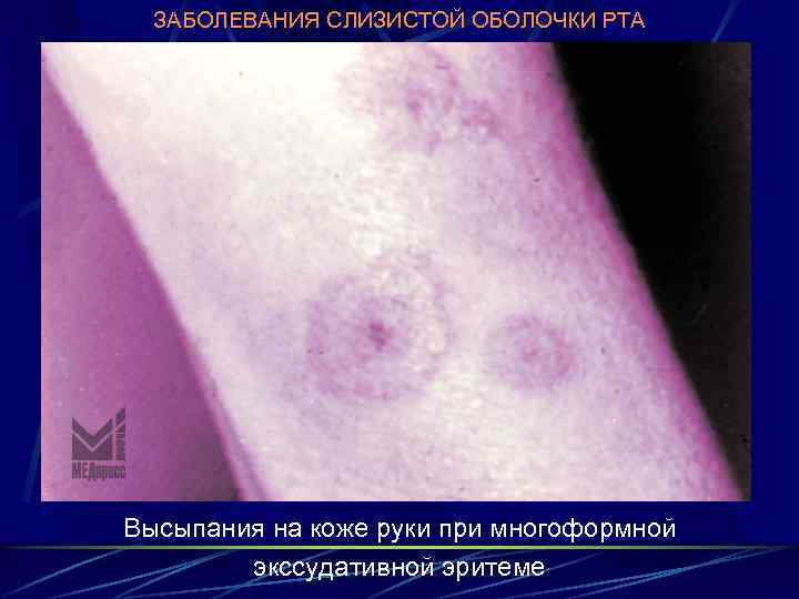 ЗАБОЛЕВАНИЯ СЛИЗИСТОЙ ОБОЛОЧКИ РТА Высыпания на коже руки при многоформной экссудативной эритеме 