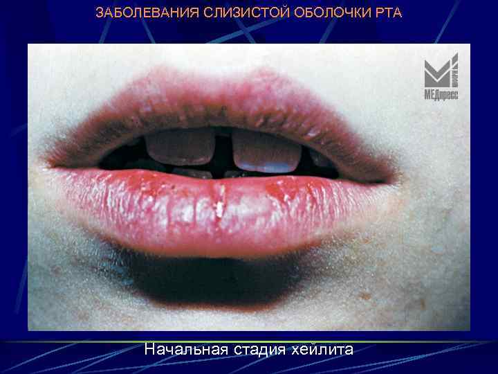 ЗАБОЛЕВАНИЯ СЛИЗИСТОЙ ОБОЛОЧКИ РТА Начальная стадия хейлита 