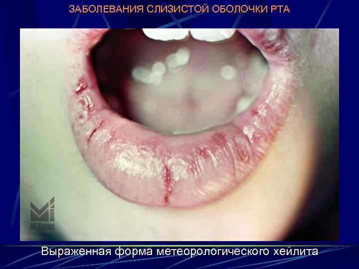 ЗАБОЛЕВАНИЯ СЛИЗИСТОЙ ОБОЛОЧКИ РТА Выраженная форма метеорологического хейлита 