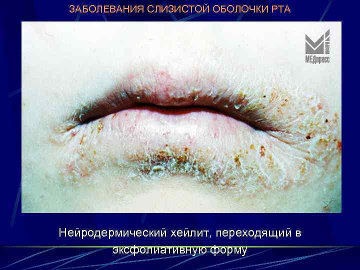 ЗАБОЛЕВАНИЯ СЛИЗИСТОЙ ОБОЛОЧКИ РТА Нейродермический хейлит, переходящий в эксфолиативную форму 