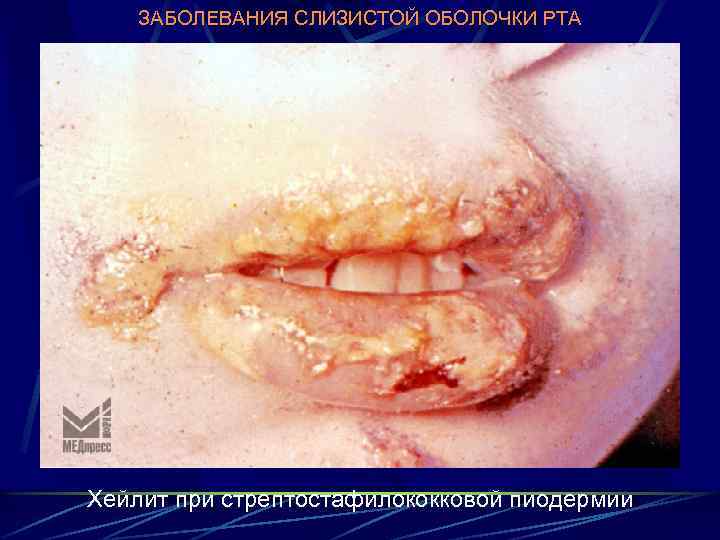 ЗАБОЛЕВАНИЯ СЛИЗИСТОЙ ОБОЛОЧКИ РТА Хейлит при стрептостафилококковой пиодермии 