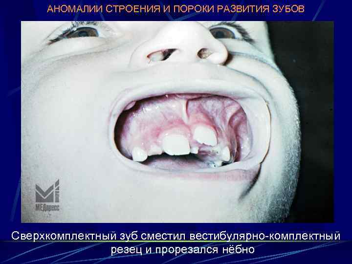 АНОМАЛИИ СТРОЕНИЯ И ПОРОКИ РАЗВИТИЯ ЗУБОВ Сверхкомплектный зуб сместил вестибулярно-комплектный резец и прорезался нёбно