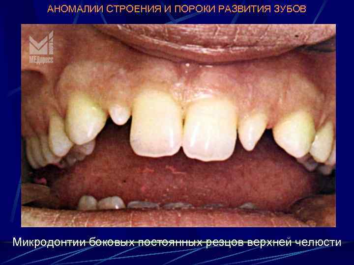 АНОМАЛИИ СТРОЕНИЯ И ПОРОКИ РАЗВИТИЯ ЗУБОВ Микродонтии боковых постоянных резцов верхней челюсти 