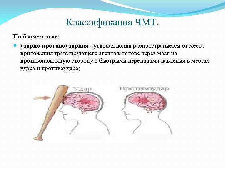 Классификация чмт. Ударно-противоударная ЧМТ. Ударно противоударная биомеханика ЧМТ. Классификация ЧМТ по биомеханике. Ударно-противоударная ЧМТ схема.