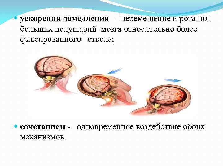 Ускорение замедления