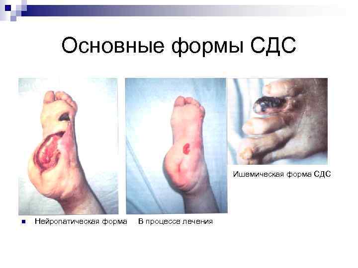 Основные формы СДС Ишемическая форма СДС n n Нейропатическая форма В процессе лечения 