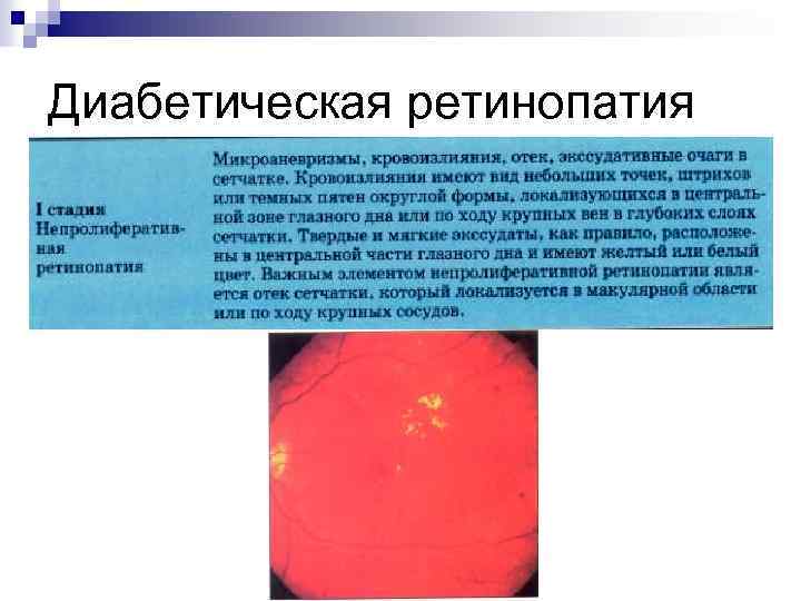 Диабетическая ретинопатия 