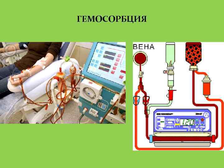 ГЕМОСОРБЦИЯ 