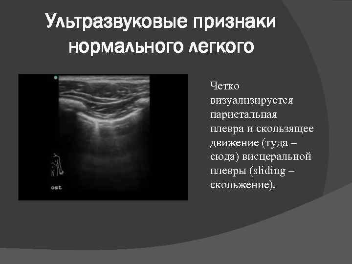 Ультразвуковые признаки нормального легкого Четко визуализируется париетальная плевра и скользящее движение (туда – сюда)