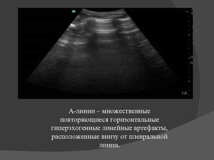 А-линии – множественные повторяющиеся горизонтальные гиперэхогенные линейные артефакты, расположенные внизу от плевральной линии. 