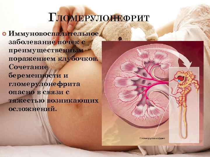 ГЛОМЕРУЛОНЕФРИТ Иммуновоспалительное заболевание почек с преимущественным поражением клубочков. Сочетание беременности и гломерулонефрита опасно в