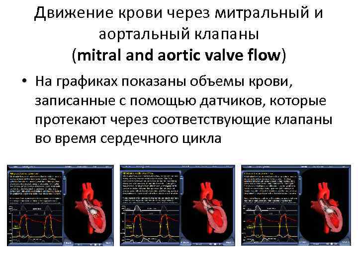 Движение крови через митральный и аортальный клапаны (mitral and aortic valve flow) • На