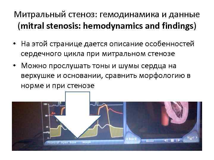 Митральный стеноз: гемодинамика и данные (mitral stenosis: hemodynamics and findings) • На этой странице