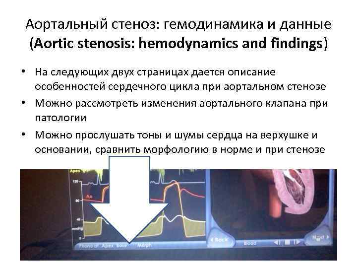 Аортальный стеноз: гемодинамика и данные (Aortic stenosis: hemodynamics and findings) • На следующих двух