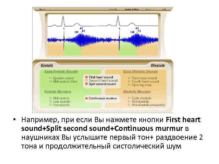  • Например, при если Вы нажмете кнопки First heart sound+Split second sound+Сontinuous murmur