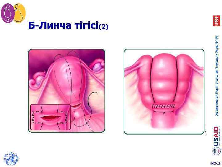 Эффективная Перинатальная Помощь и Уход (ЭПУ) Б-Линча тігісі(2) 4 MO-19 